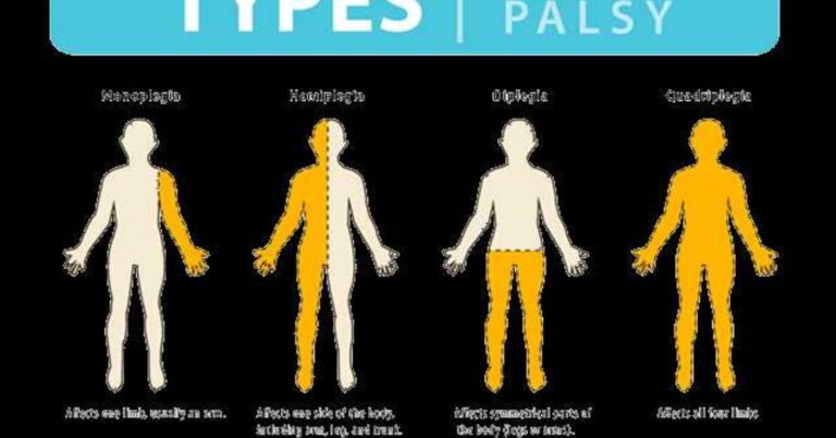Cerebral Palsy Stem Cell Therapy in India: A New Dawn in Pediatric Neurology